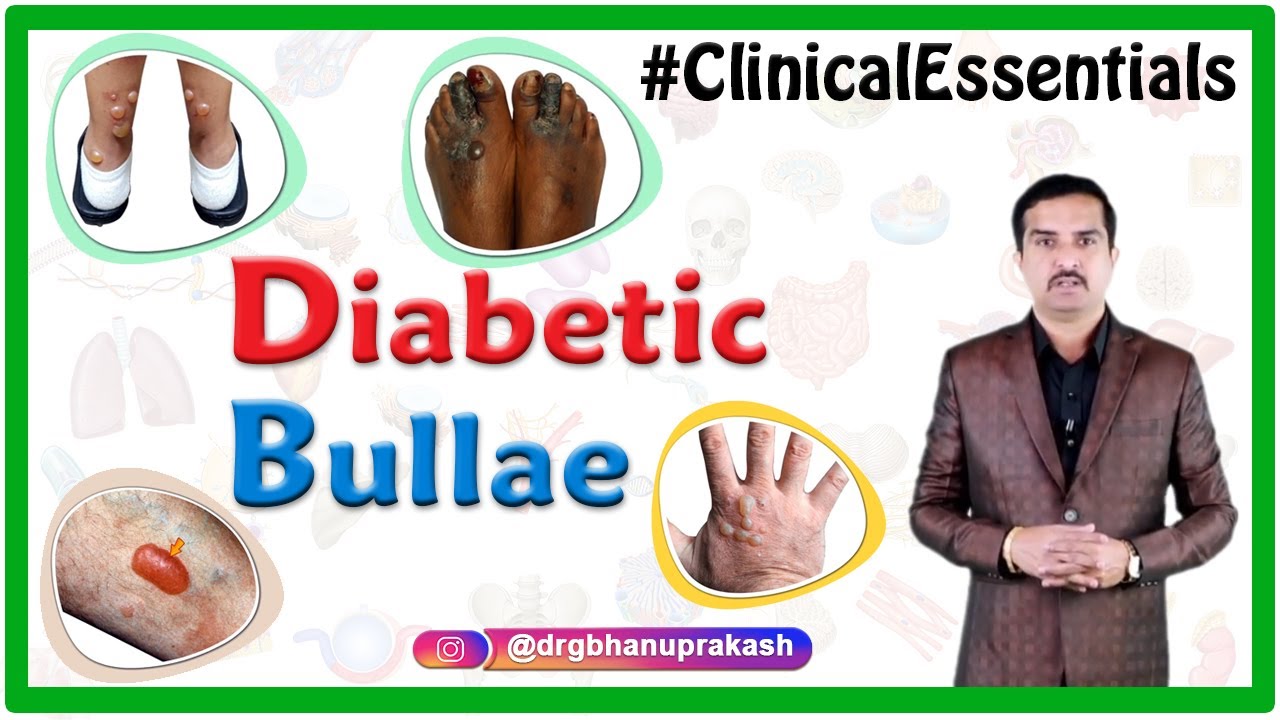Diabetic bullae (Bullosis Diabeticorum) - Clinical essentials : Dr G Bhanu Prakash