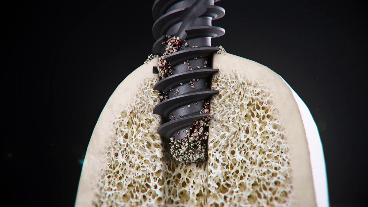 Straumann&reg; BLX Implant System - Full Length Chip Flutes Dynamic Bone Management
