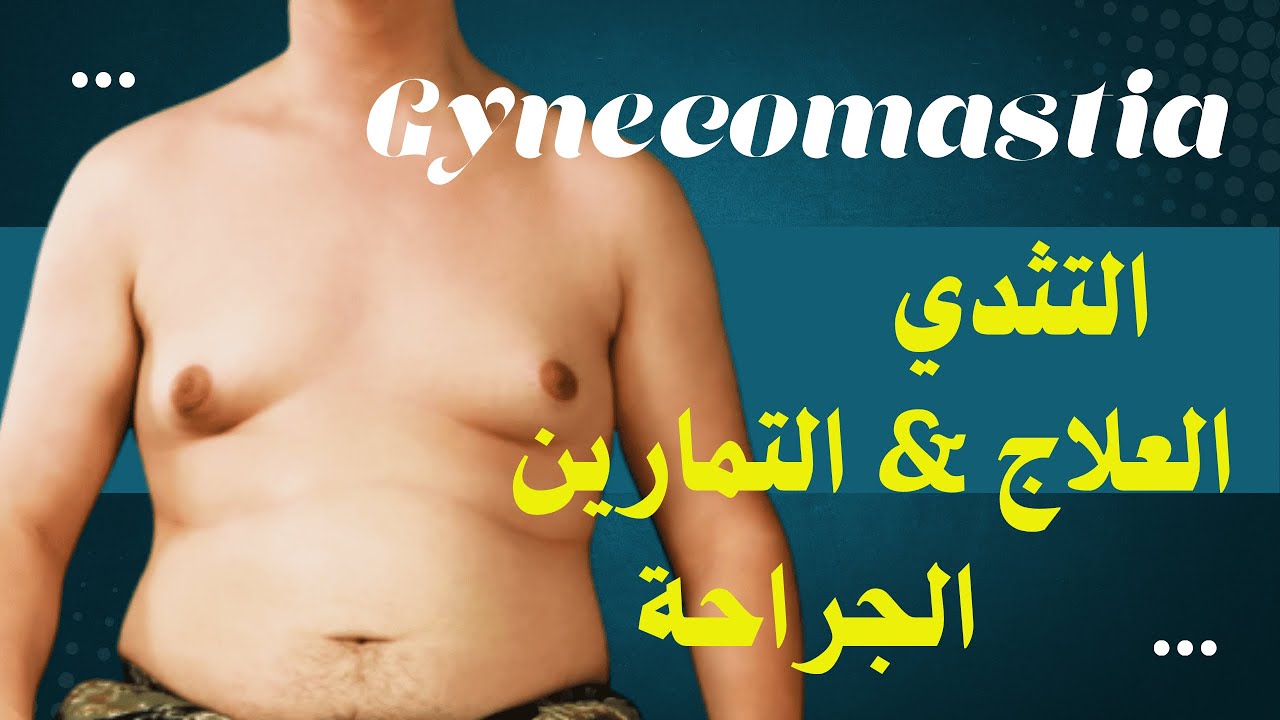 كل ما تحتاج تعرفه عن التثدي عند الرجال | الأسباب، الأعراض، والعلاج الجراحي والدوائي