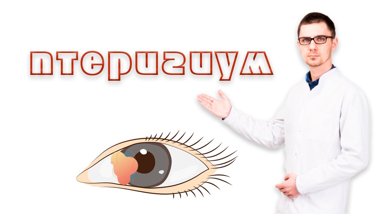 Птеригиум или пленка на глазу
