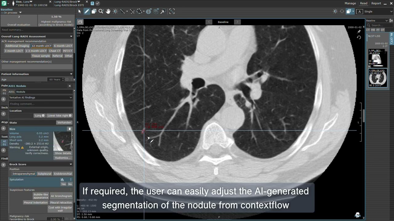 Lung Cancer Screening & Nodule Management