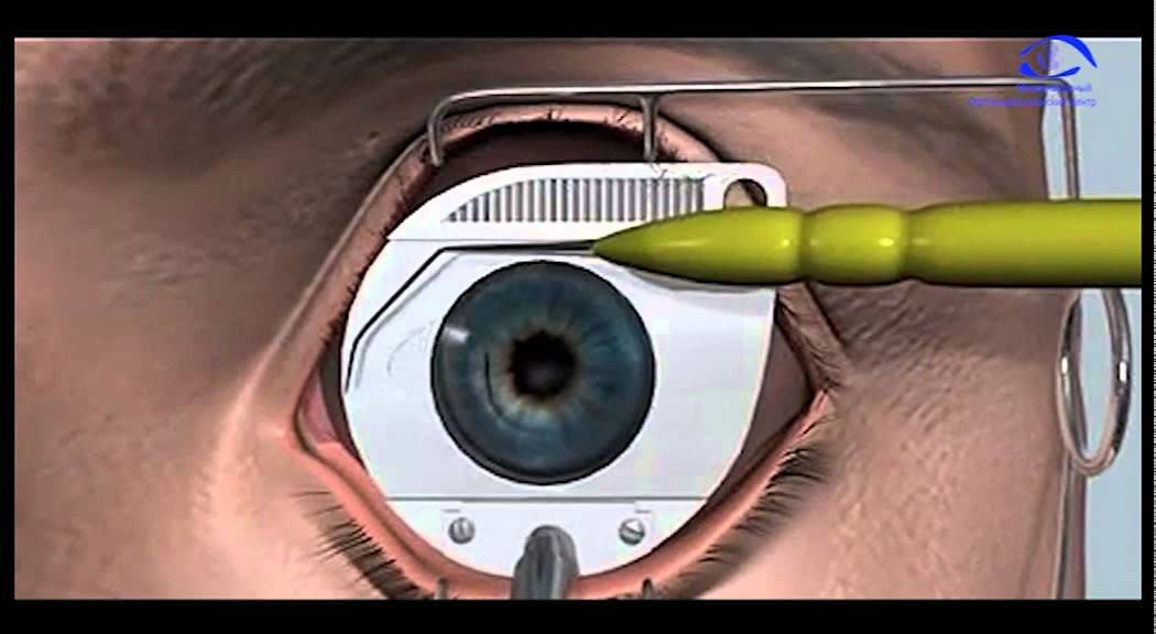 Лазерная коррекция зрения SUPER LASIK