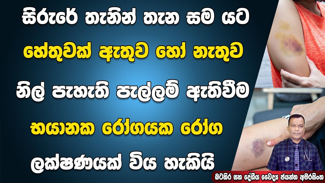 සිරුරේ සම යට නිල් පැහැති පැල්ලම් ඇතිවීම බරපතල රෝගයක ලක්ෂණයක් විය හැකියි Bruising | Ecchymotic patch