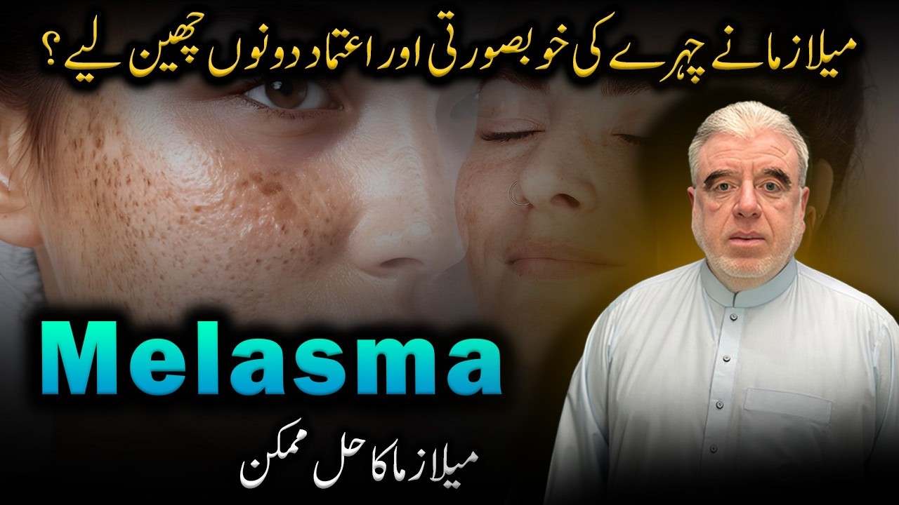 Melasma Causes, Symptoms & Effective Treatments | How to Reduce Dark Spots on Face Naturally