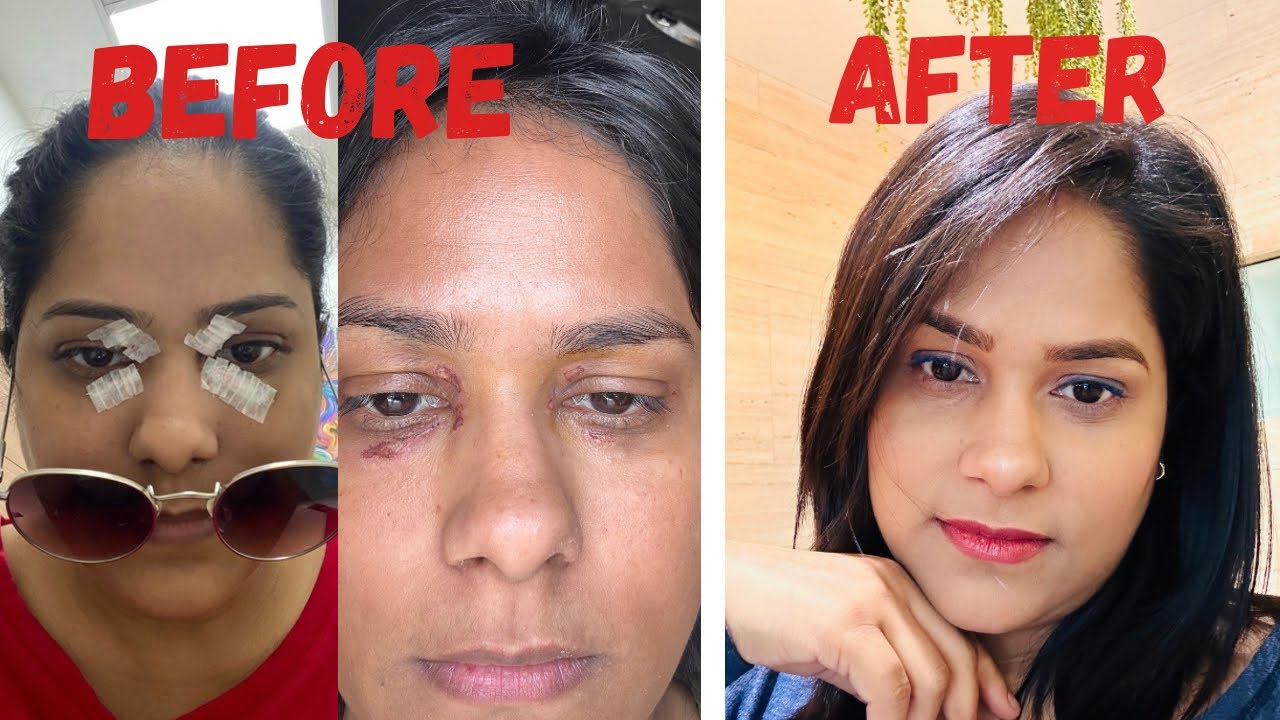 Cholesterol Deposit Removal Before and After | Xanthelasma Removal