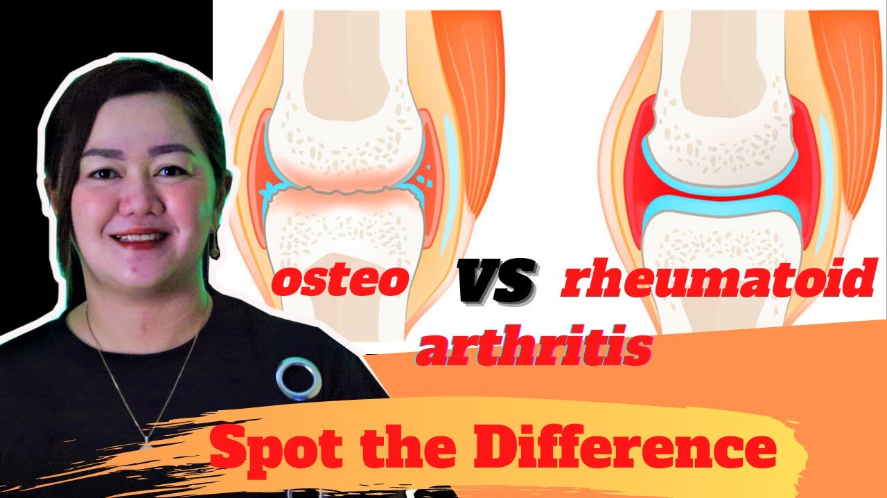 The similarities & differences of Osteoarthritis & Rheumatoid Arthritis | Doc Cherry