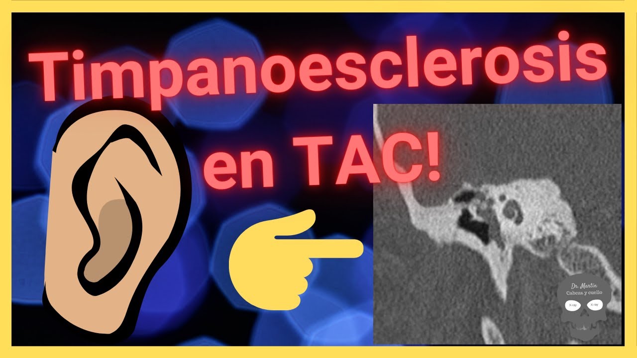 Timpanoesclerosis 👂🏽HALLAZGOS RADIOLÓGICOS