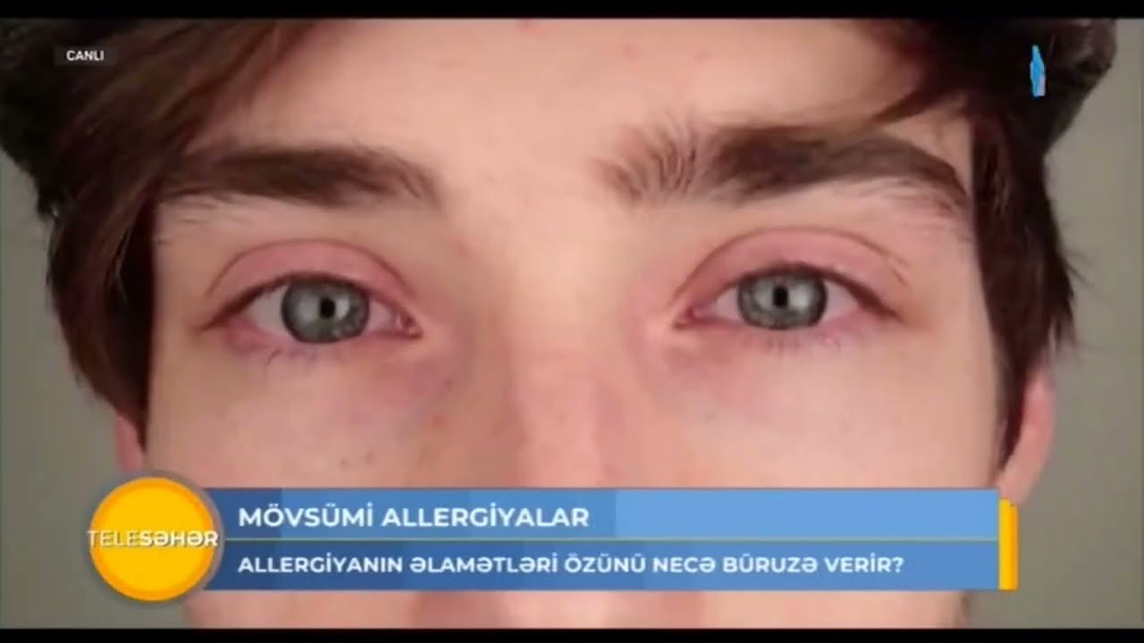 Allergiyanın əlamətləri özünü necə büruzə verir?