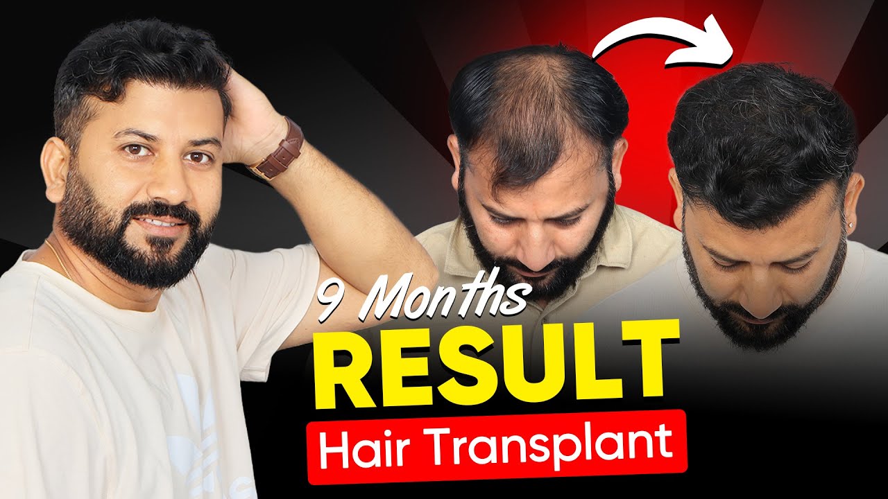 Unbelievable 9-Month Hair Transplant Result (HXQSDN) &ndash; Before & After
