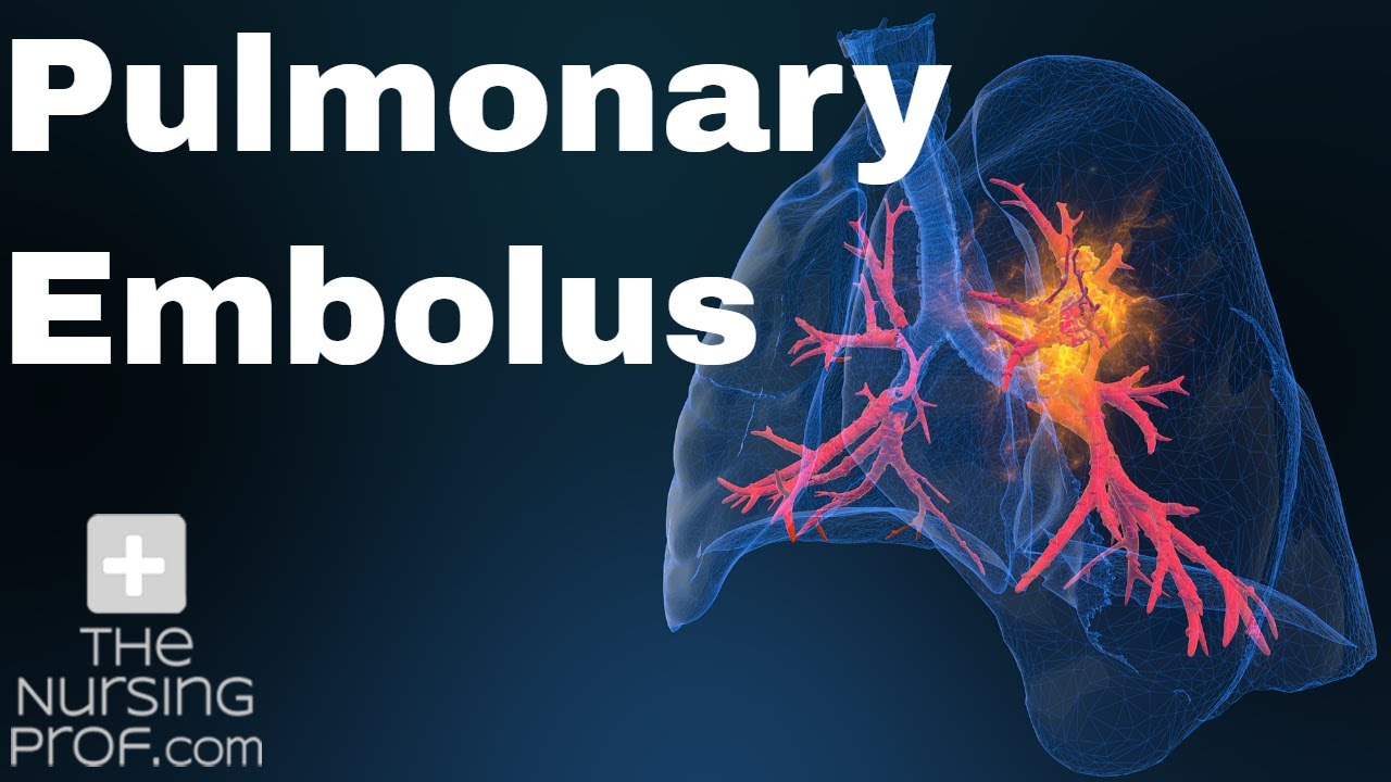 Pulmonary Embolus Nursing Care