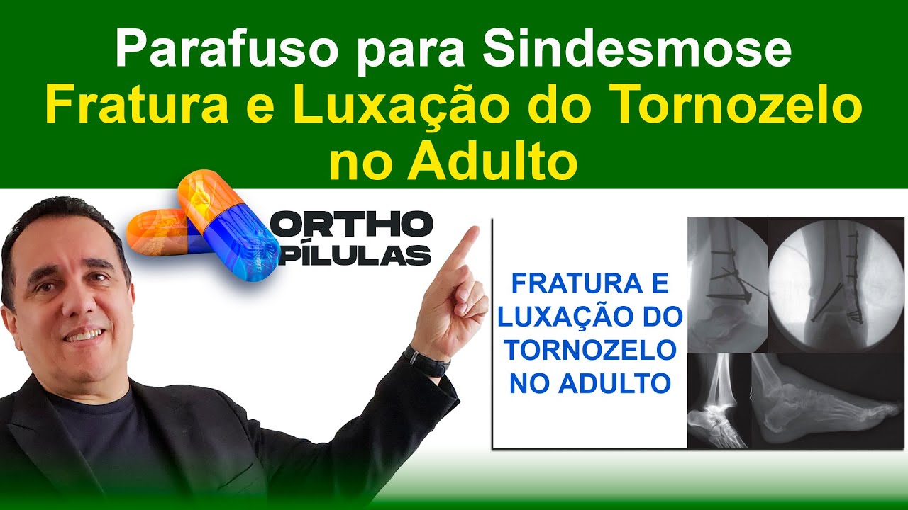 Parafuso para Sindesmose - Fratura e Luxação do Tornozelo no Adulto