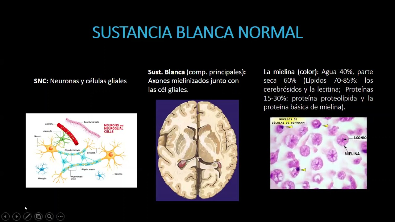 diagnostico y seguimiento de la esclerosis multiple