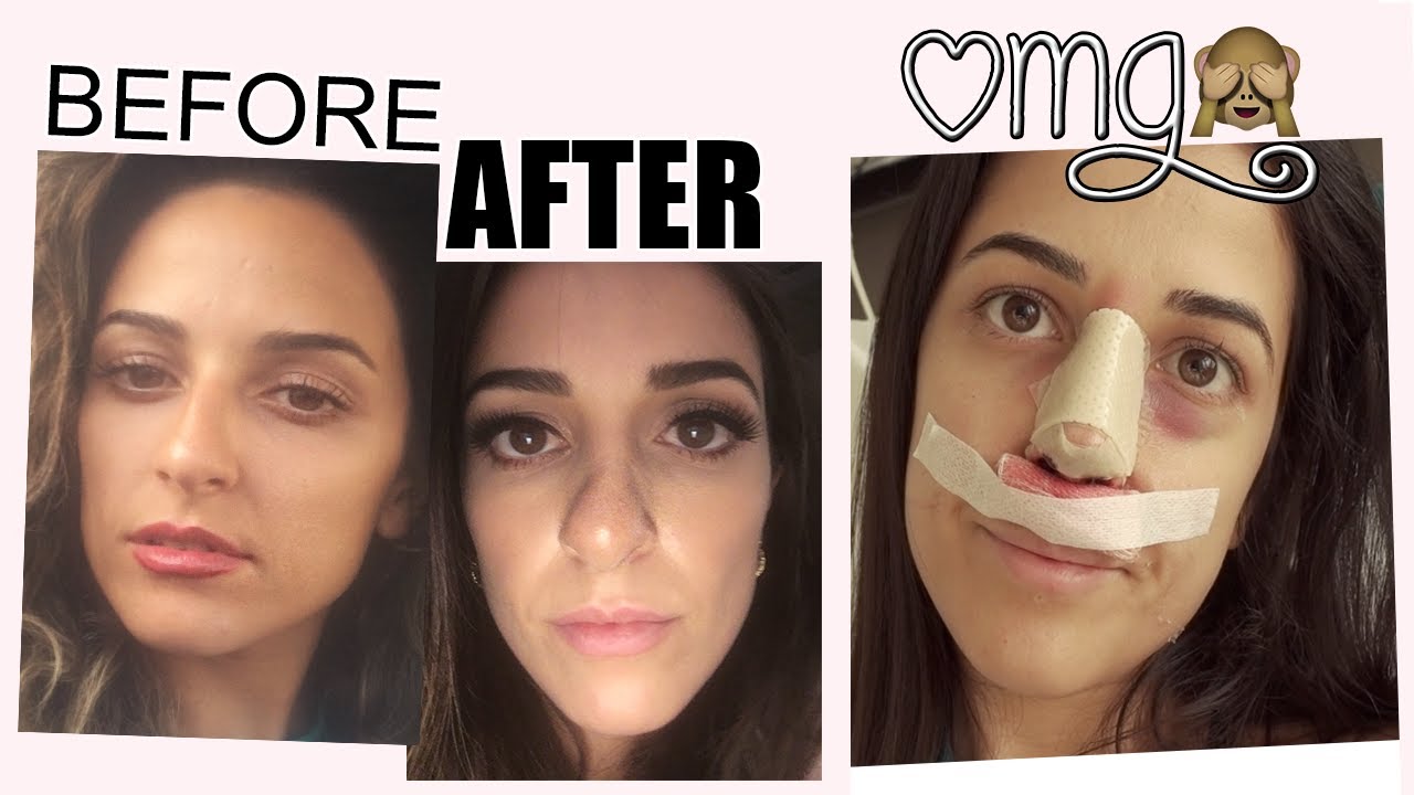 MY NOSE JOB (REVISION RHINOPLASTY) EXPERIENCE IN TURKEY | my botched nose & travelling alone |PART 1