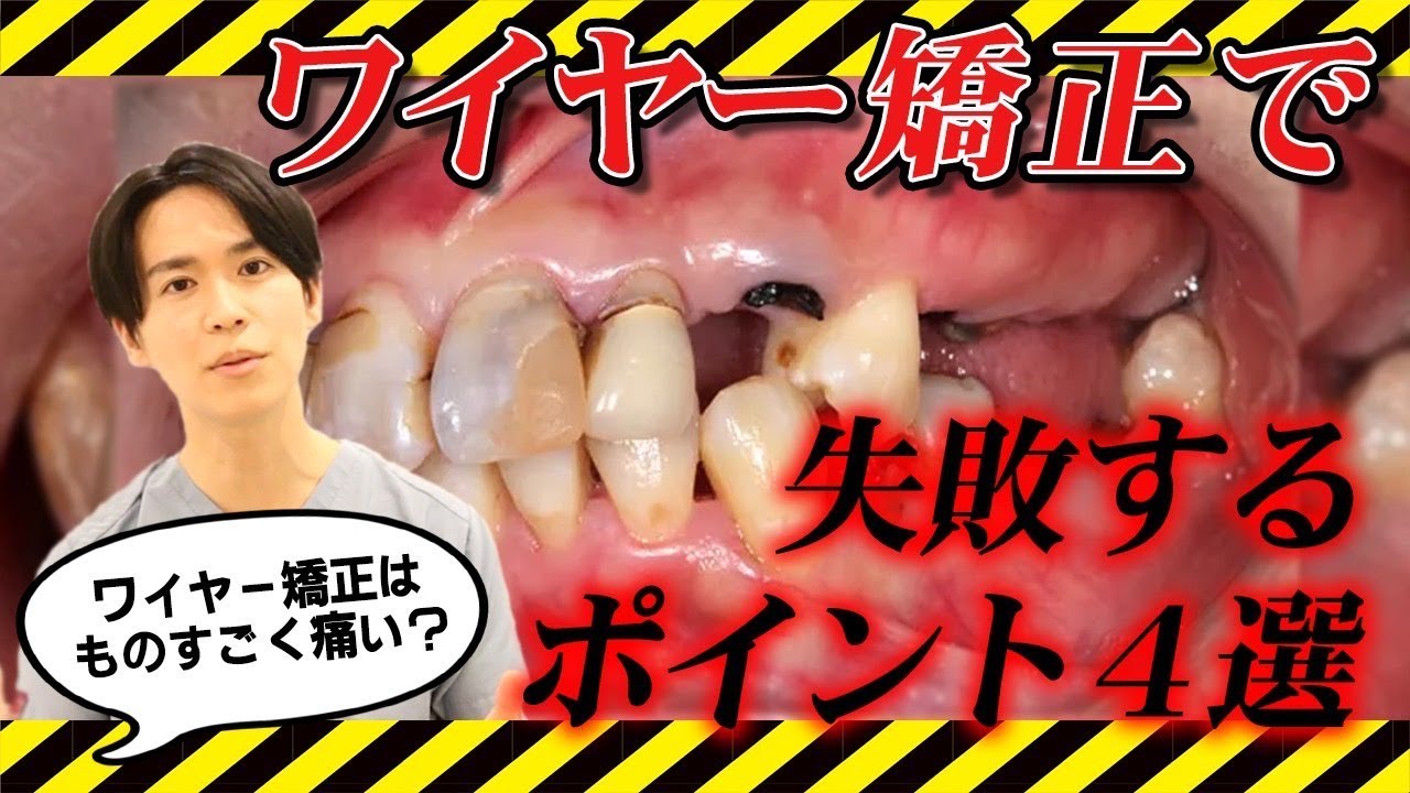 【矯正医が教える！】ワイヤー矯正で失敗する人の特徴！！