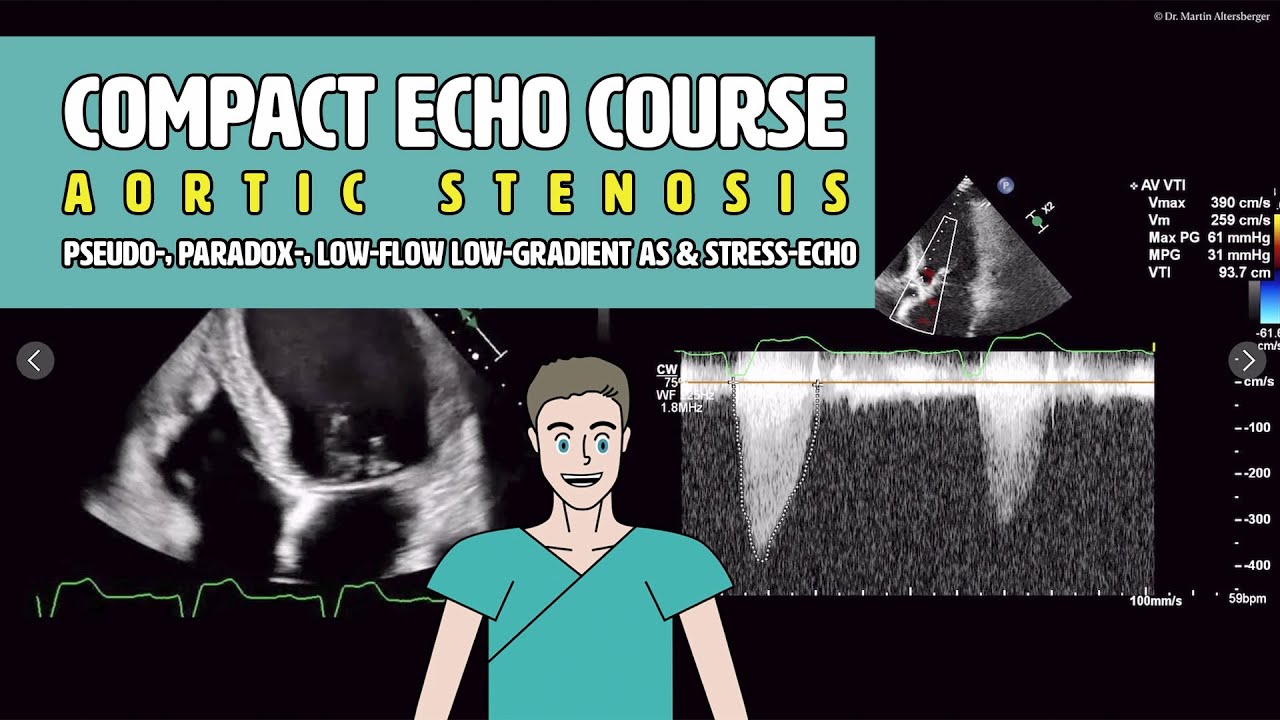 〖Echocardiography〗 Paradox-, Pseudo-, & low-flow low-gradient AS & dobutamine Stressecho 🫀