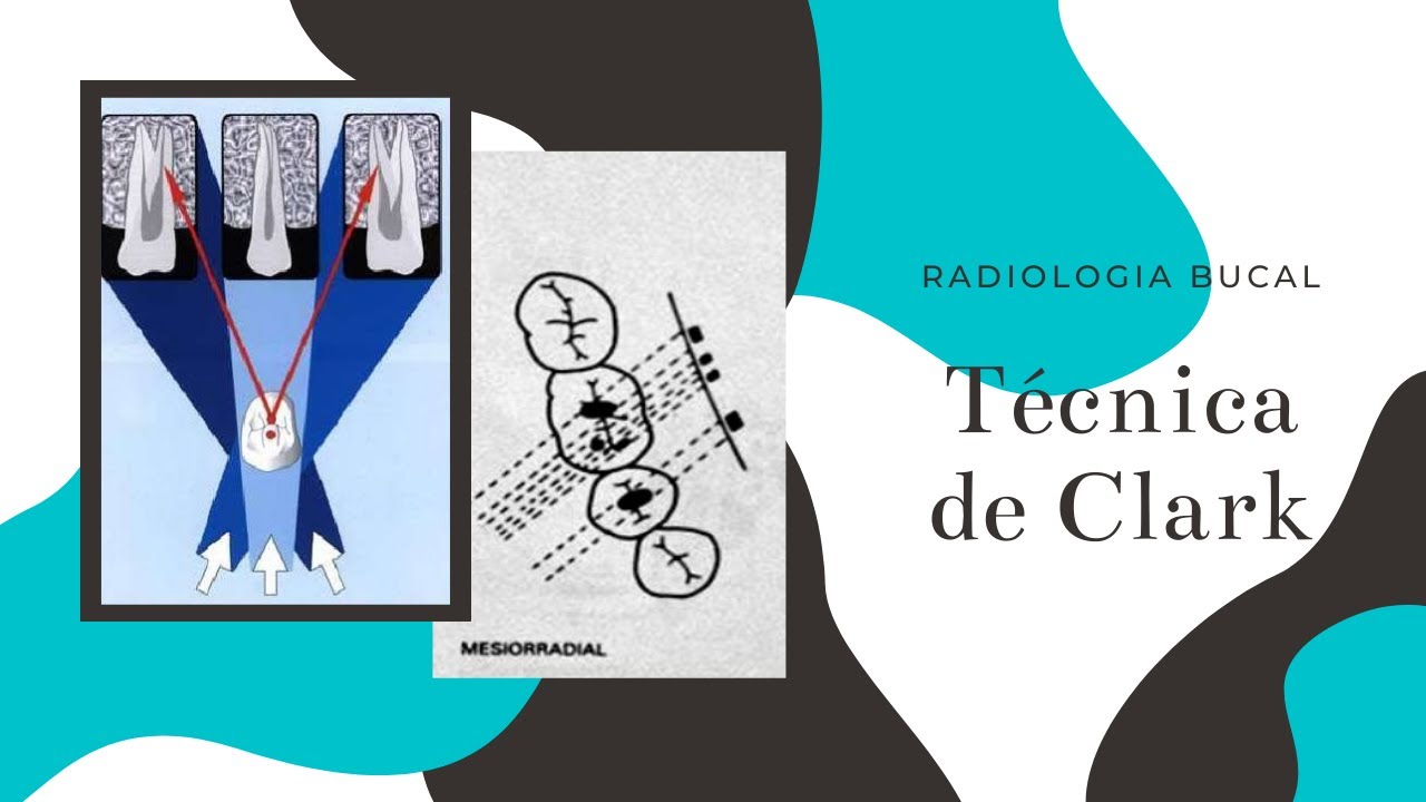 Tecnica de Clark- Radiología