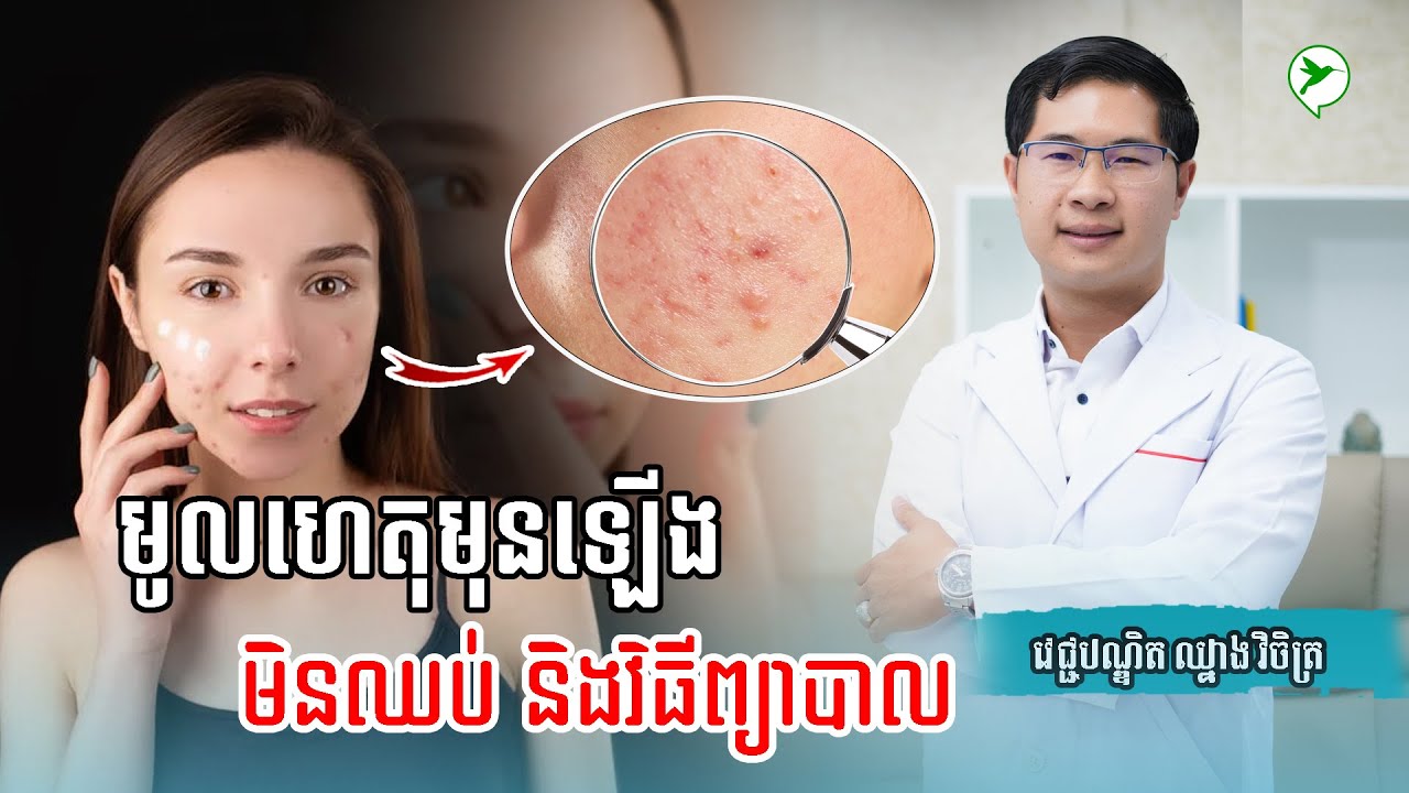 ប្រធានបទ៖ មូលហេតុនៃការឡើងមុននៅលើមុខ និងវិធីព្យាបាលកុំឱ្យកើតមុន