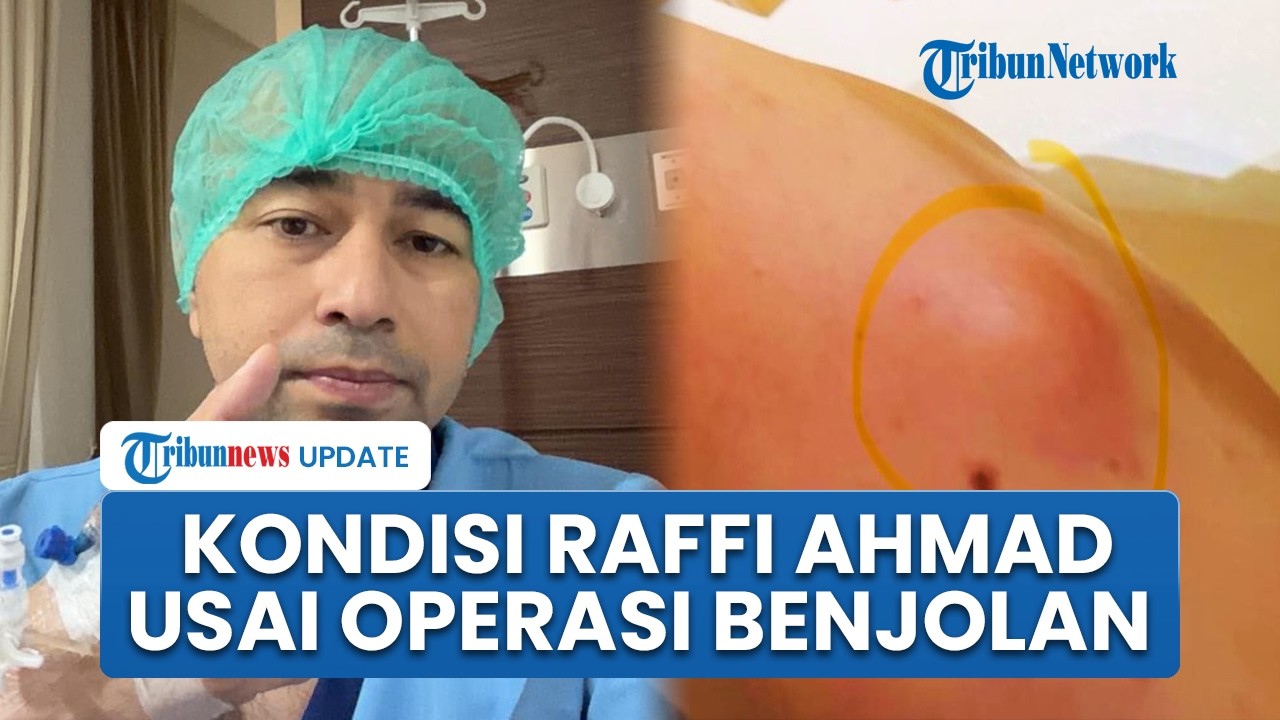 Raffi Ahmad Beberkan Hasil Rontgen Usai Operasi Bahu akibat Lipoma, Bagikan Kondisi Terkini