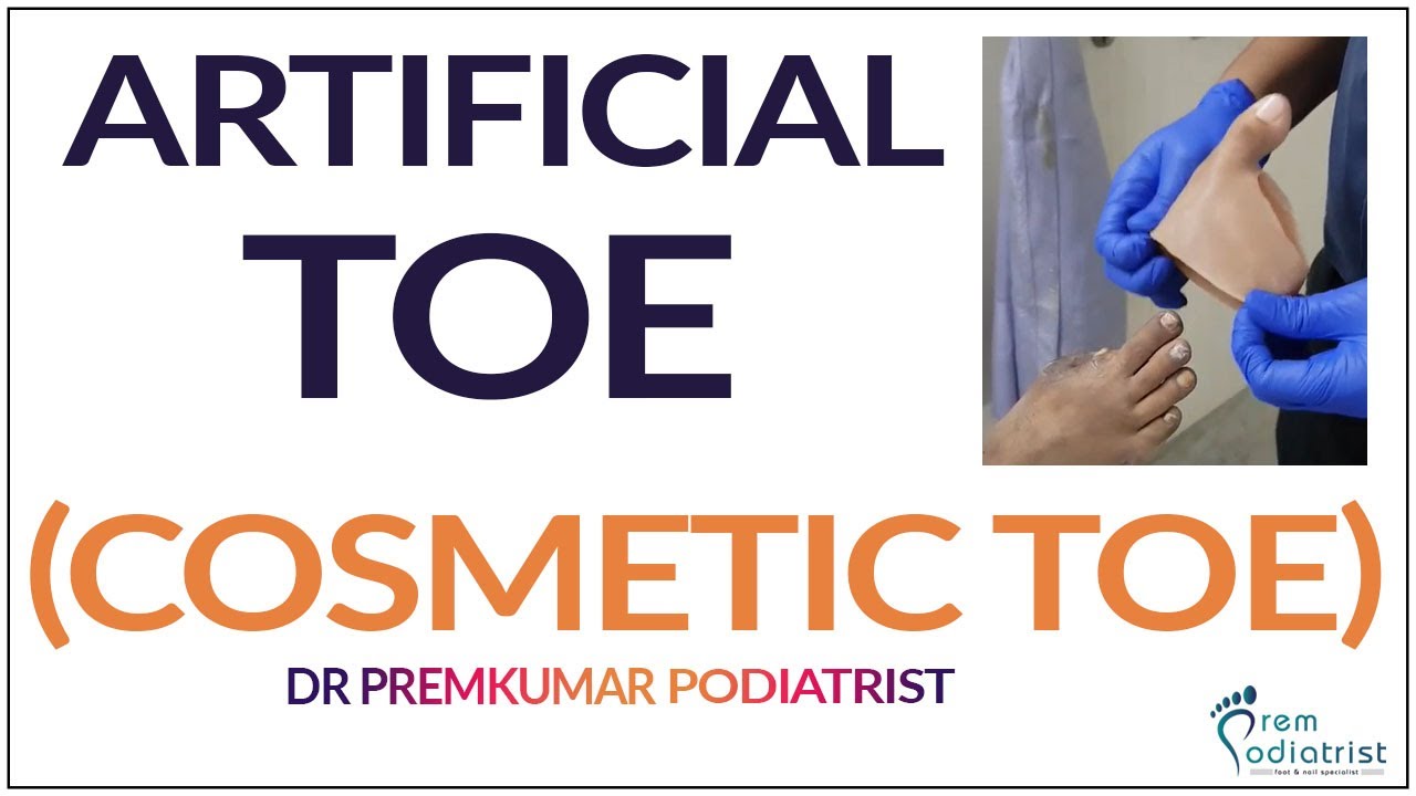 #Artificialtoe
#Artificial finger 
#cosmeticfinger
#DrPremsDiabeticFoot
#PodiatristChennai
#Diabetes
