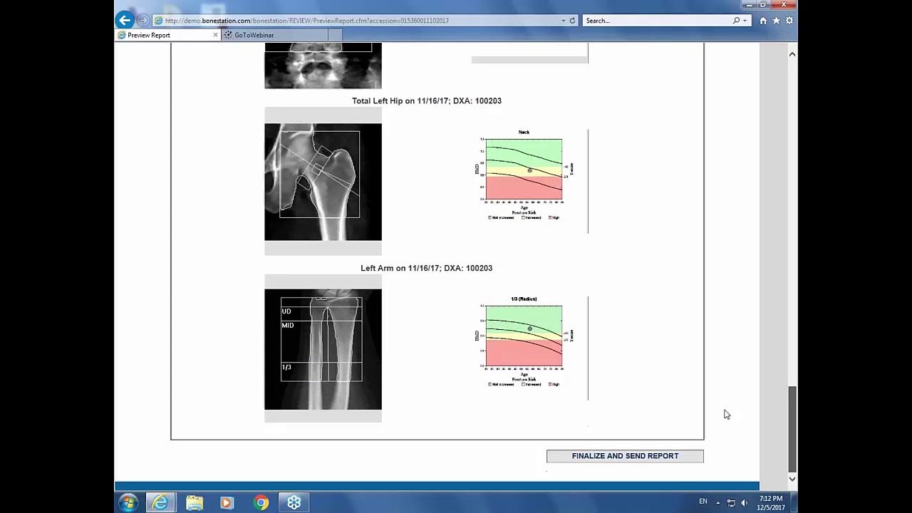 Webinar: Bone Densitometry Reporting in High Volume Practices