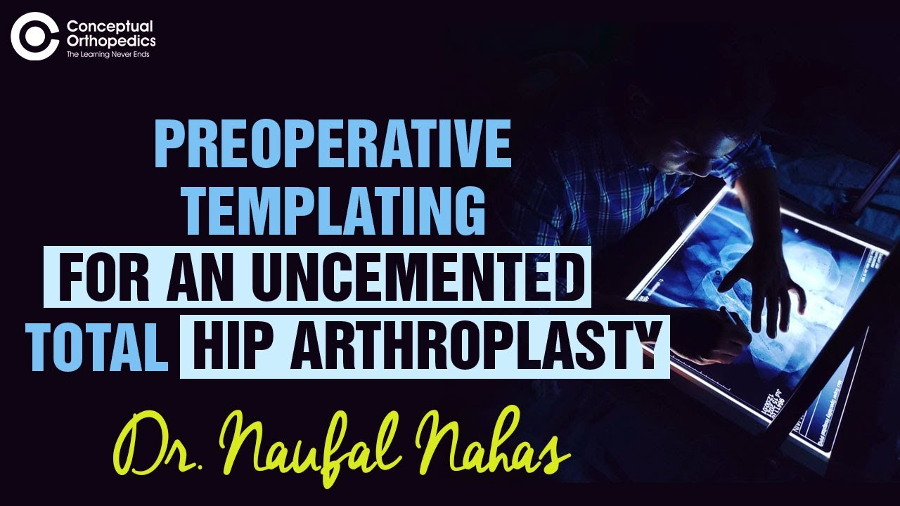 Preoperative Templating in an Uncemented Total Hip Arthroplasty by Dr. Naufal Nahas