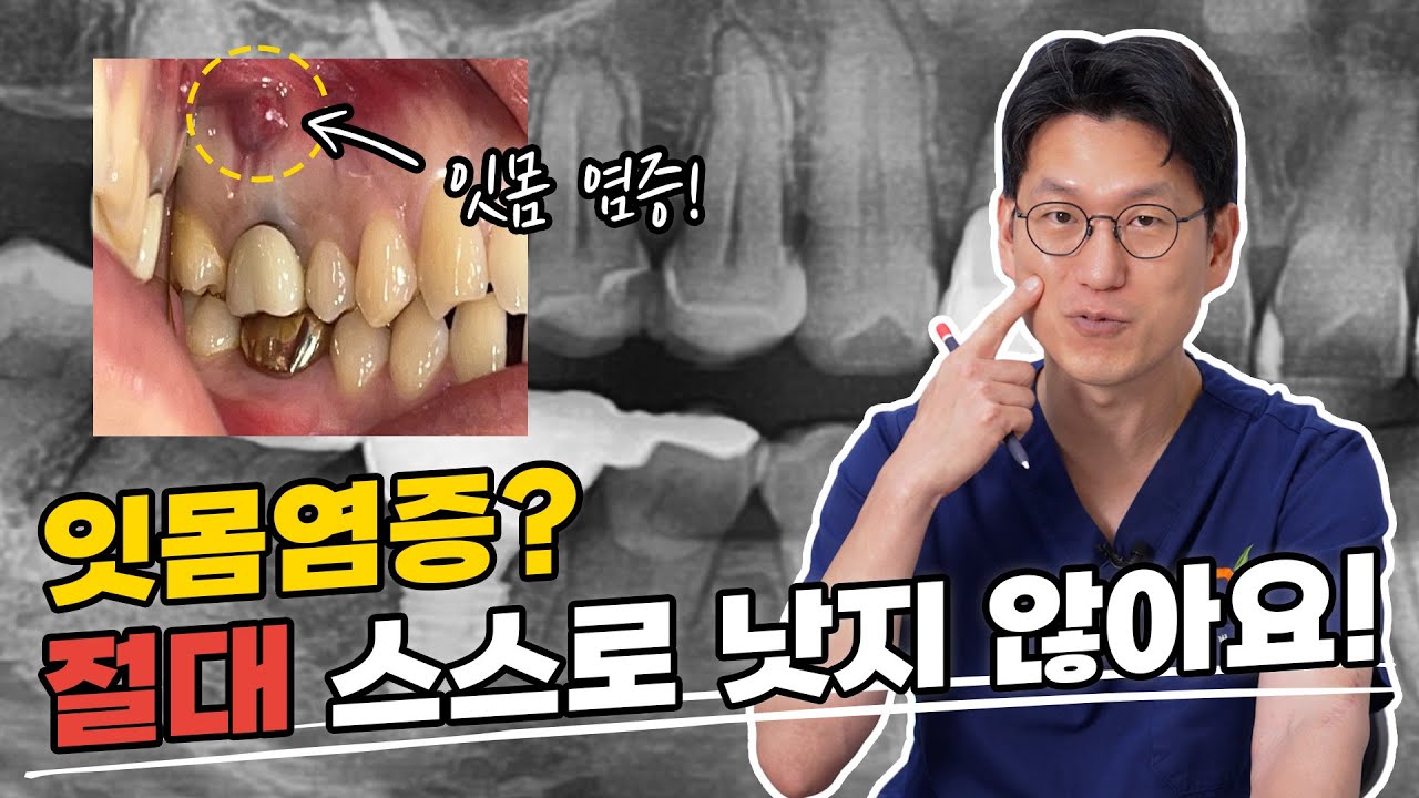 잇몸고름 발치 진단? 치근단절제술로 어금니 살리고 임플란트 피하는 법!