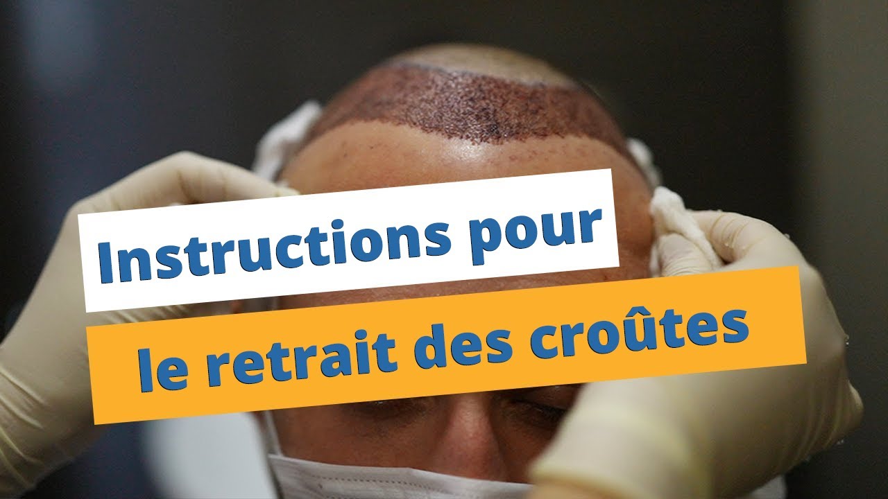 Enlever les croûtes après une greffe de cheveux ►Instruction sur le retrait des croûtes ◄