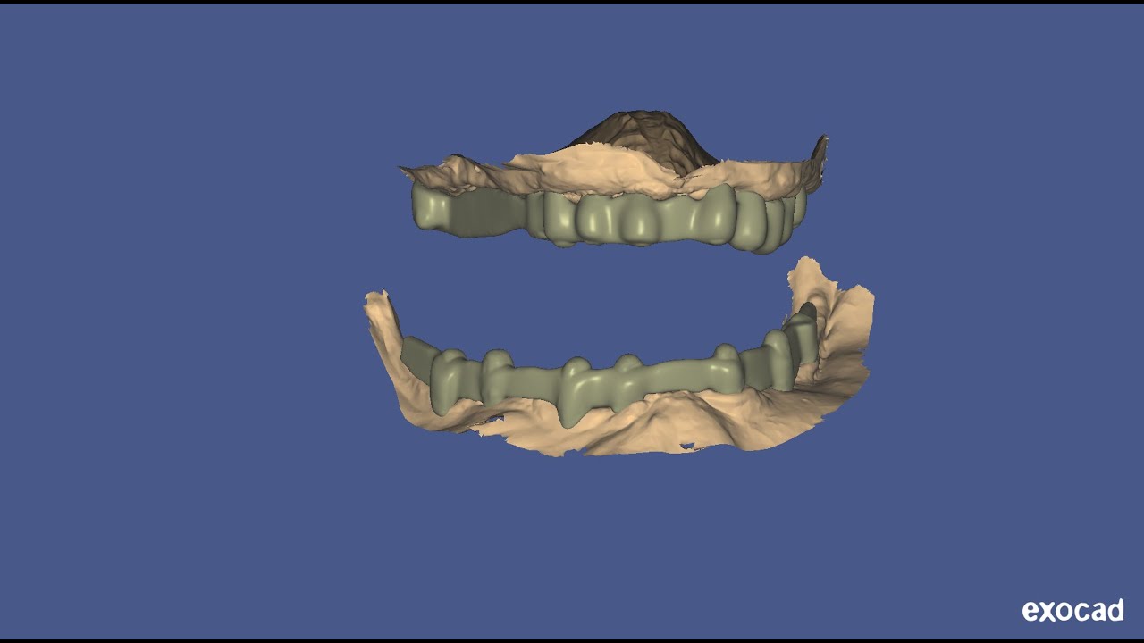 How to design upper & lower cement retained bar for full mouth- best laser dental clinic