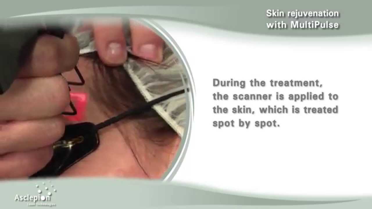 Fractional skin rejuvenation with the MultiPulse CO2 laser by Asclepion