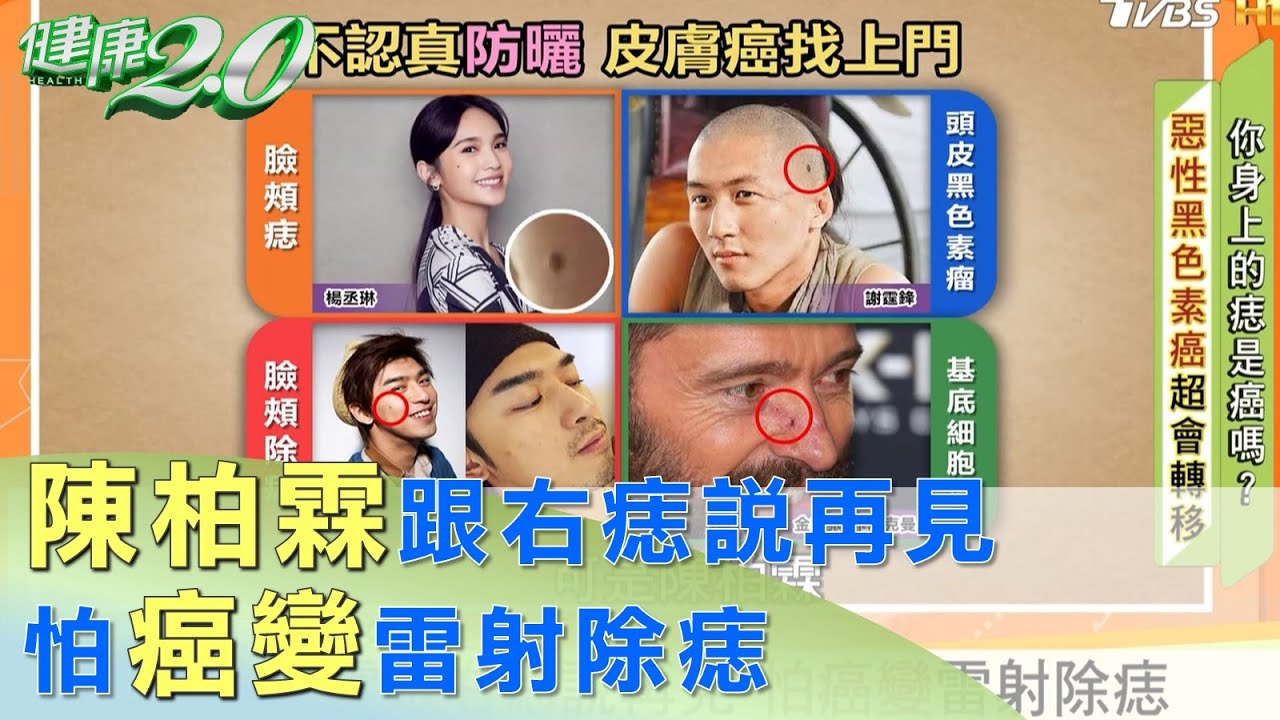 陳柏霖跟右痣說再見 怕癌變雷射除痣 健康2.0