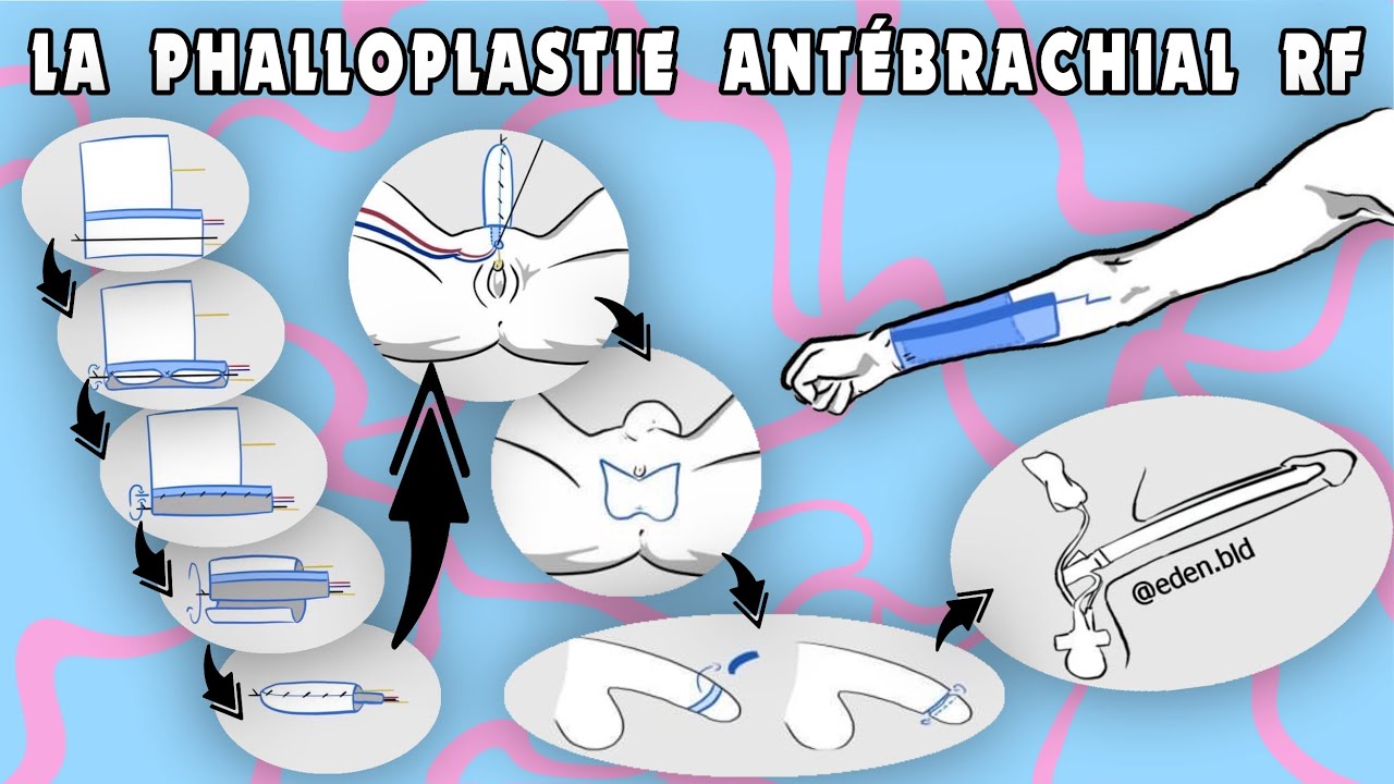 Phalloplastie antébrachial RF// Ftm transgenre français