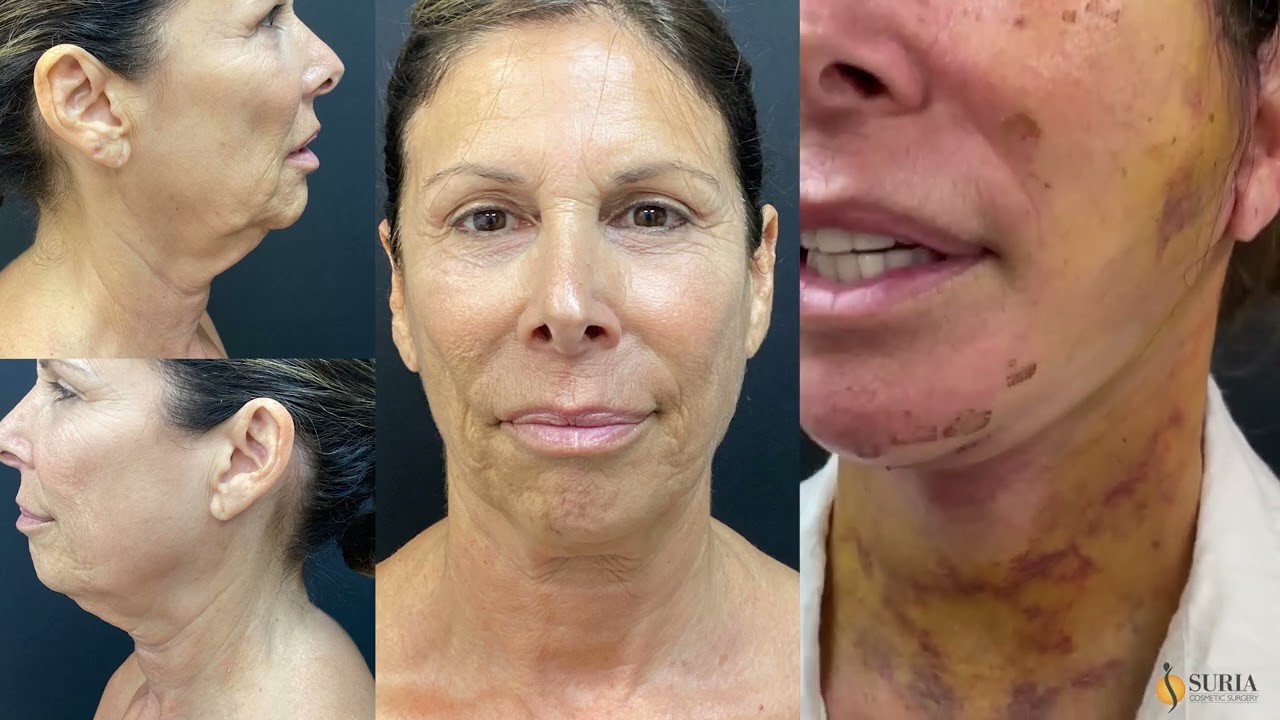 Lower Face & Neck Lift patient journey  @suriaplasticsurgery  |Dr. Shashi Kusuma
