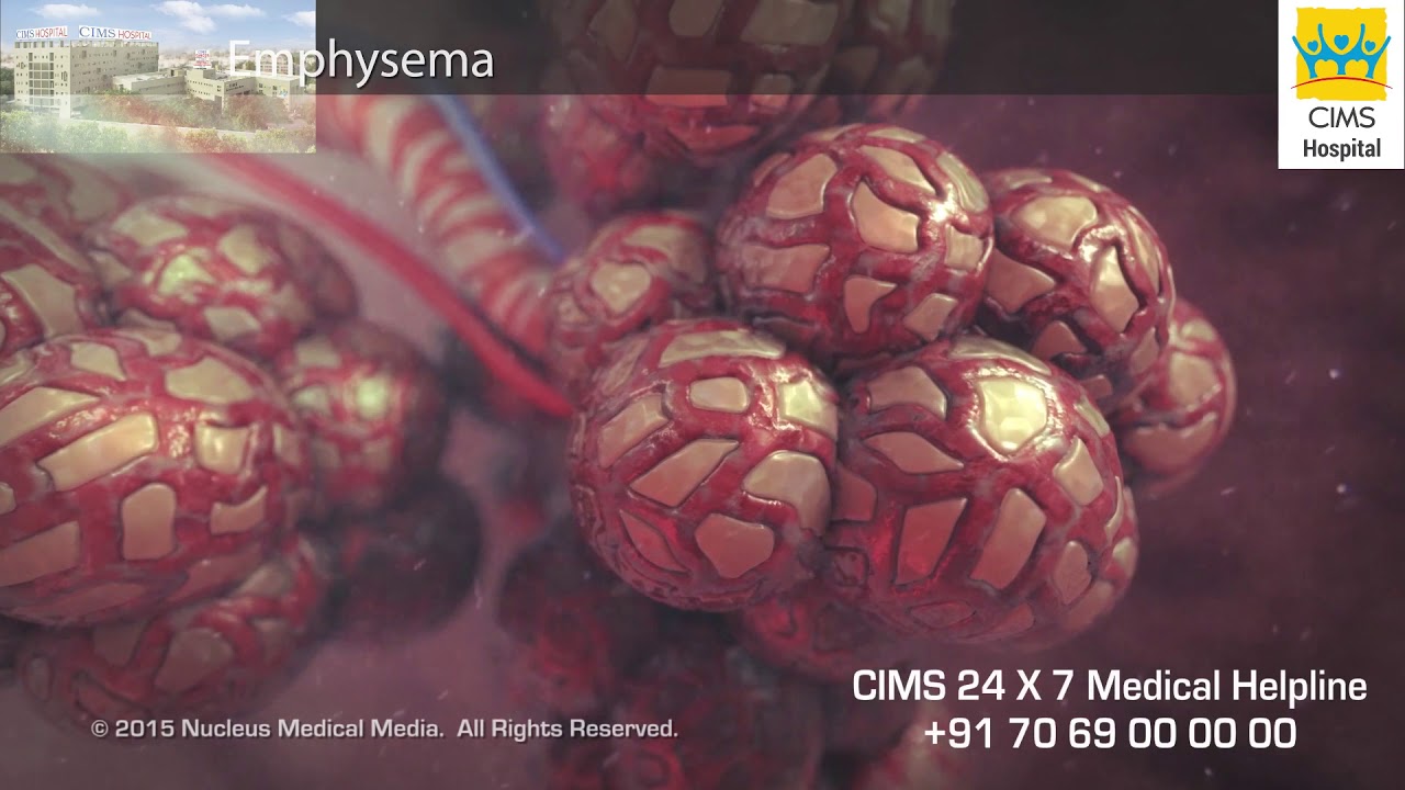 COPD (Hindi) - CIMS Hospital