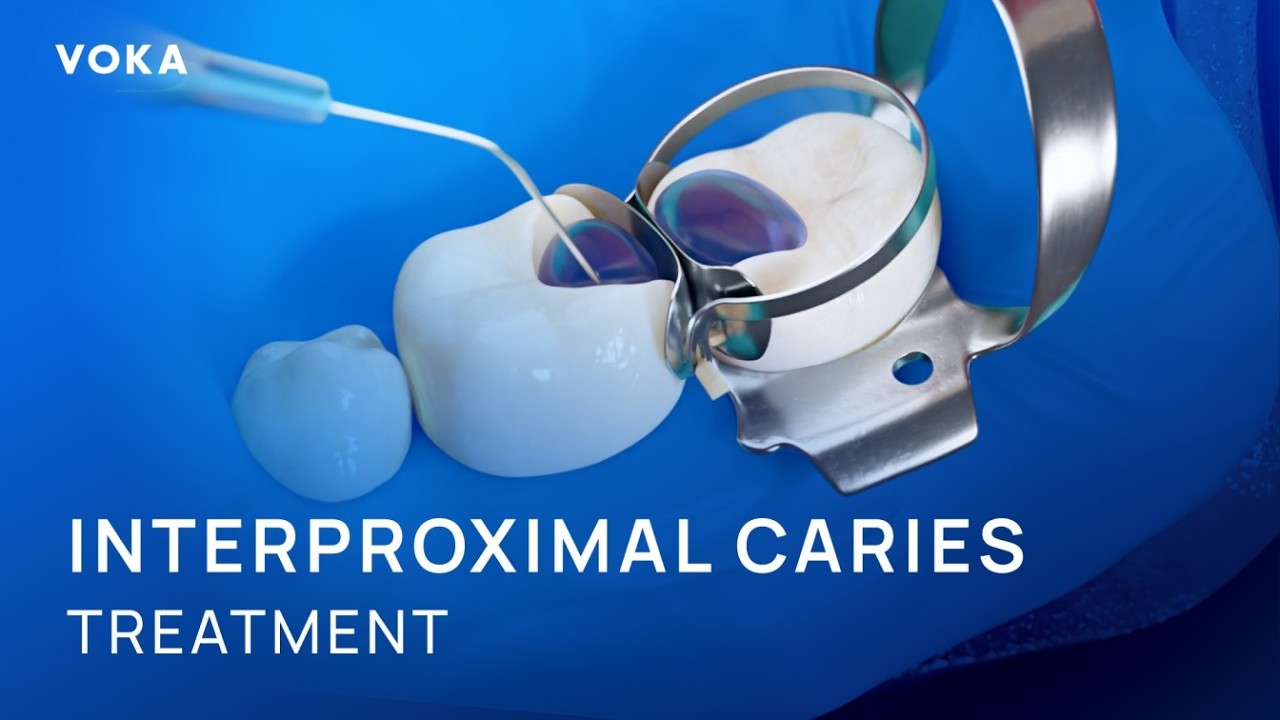 Interproximal Caries Treatment: Composite Restoration Step-by-Step in 3D