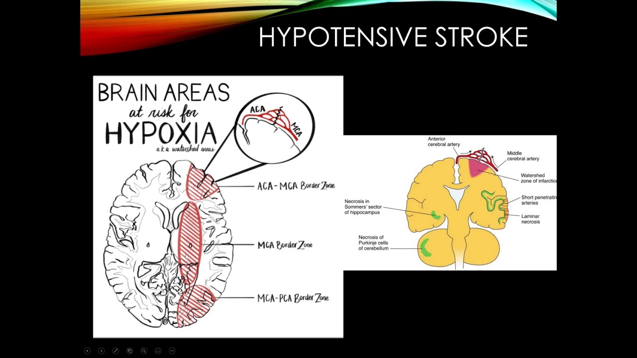 Cerebrovascular Disease,  Part 2