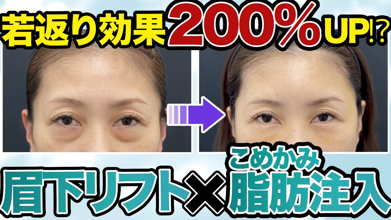 眉下＋こめかみ脂肪注入　キズをカバーし若返り効果もアップ　