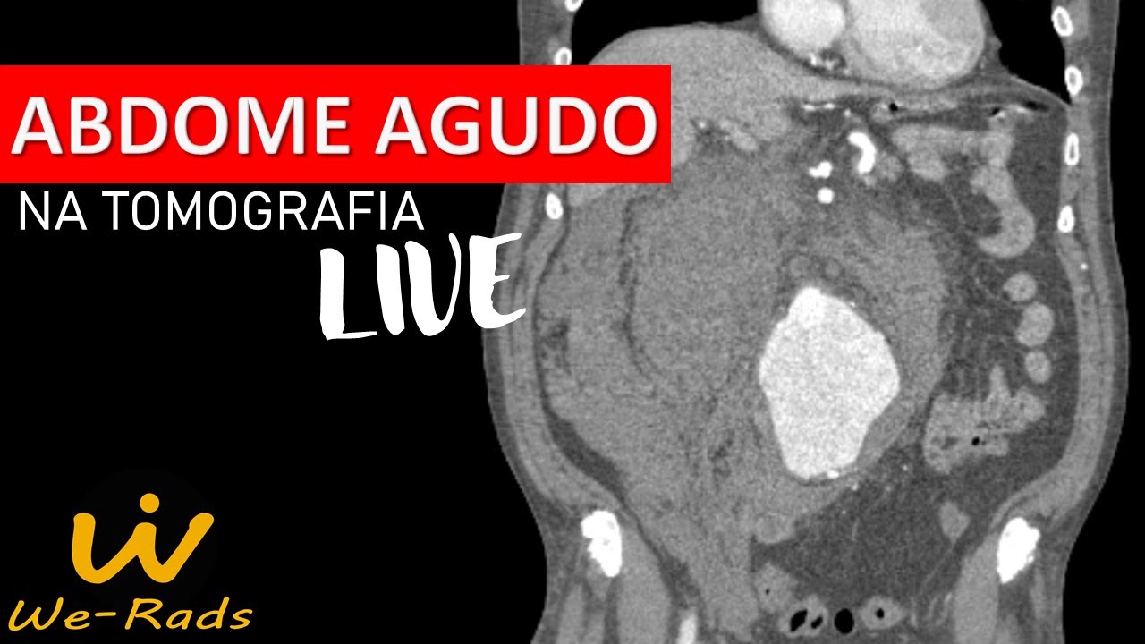 Abdome Agudo na Tomografia
