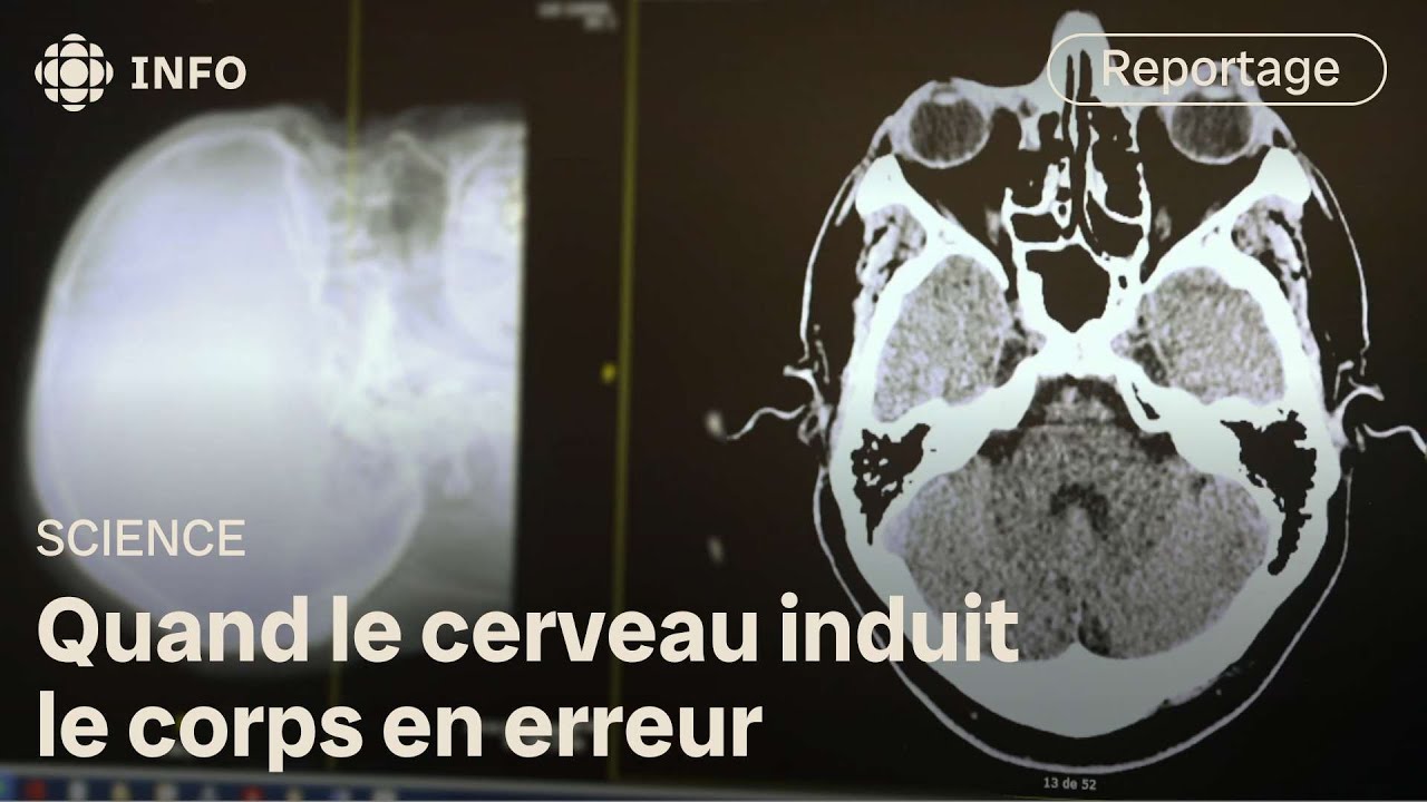 Trouble neurologique fonctionnel : quand le cerveau déraille | Découverte