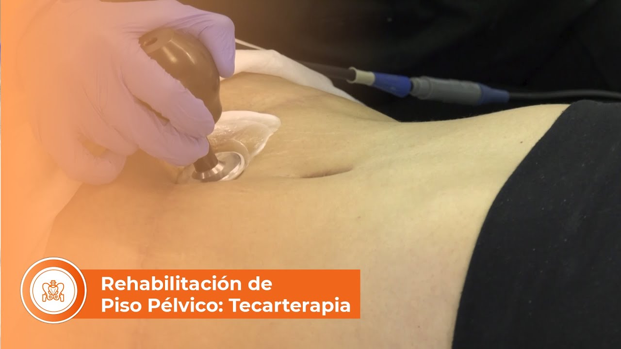 Rehabilitación del piso pélvico: Tecarterapia