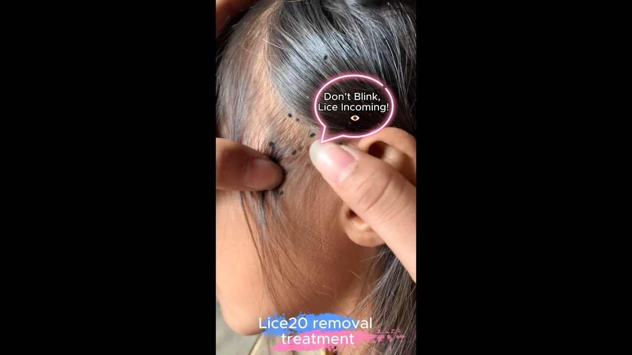 (Part 08) Lice Removal & Treatment  Satisfying Lice Popping