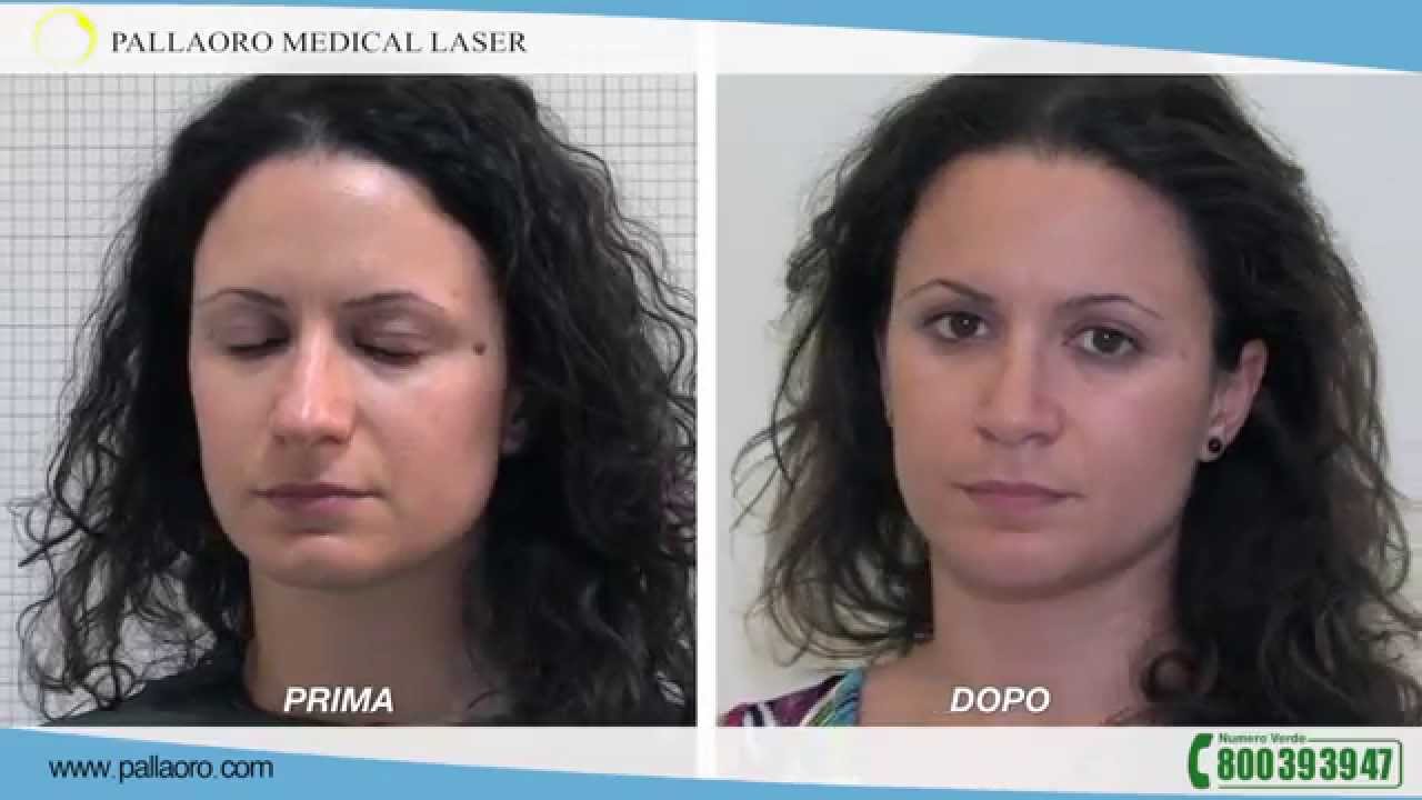 Chirurgia estetica del naso: Testimonianza di Silvia