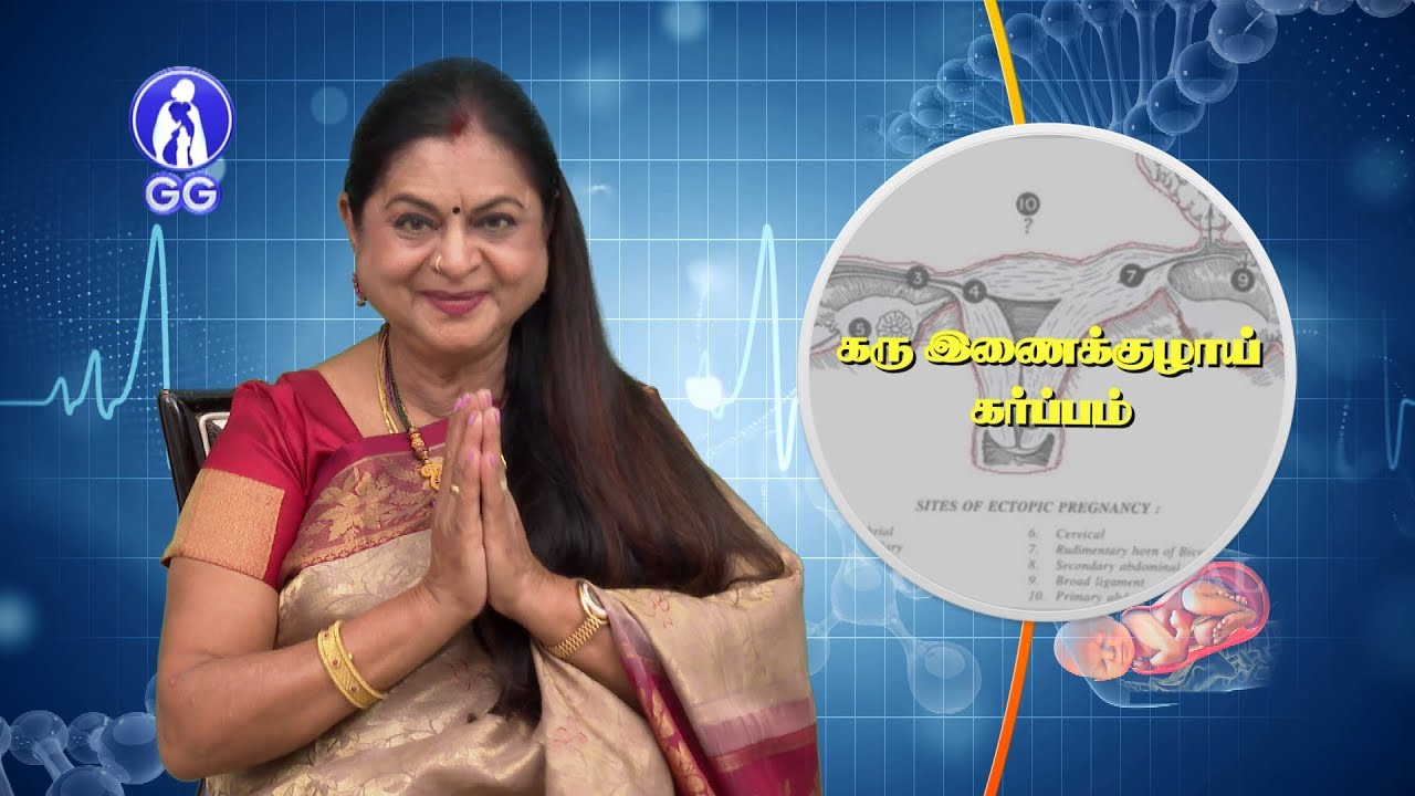 ECTOPIC PREGNANCY - GG HOSPITAL - Dr. KAMALA SELVARAJ