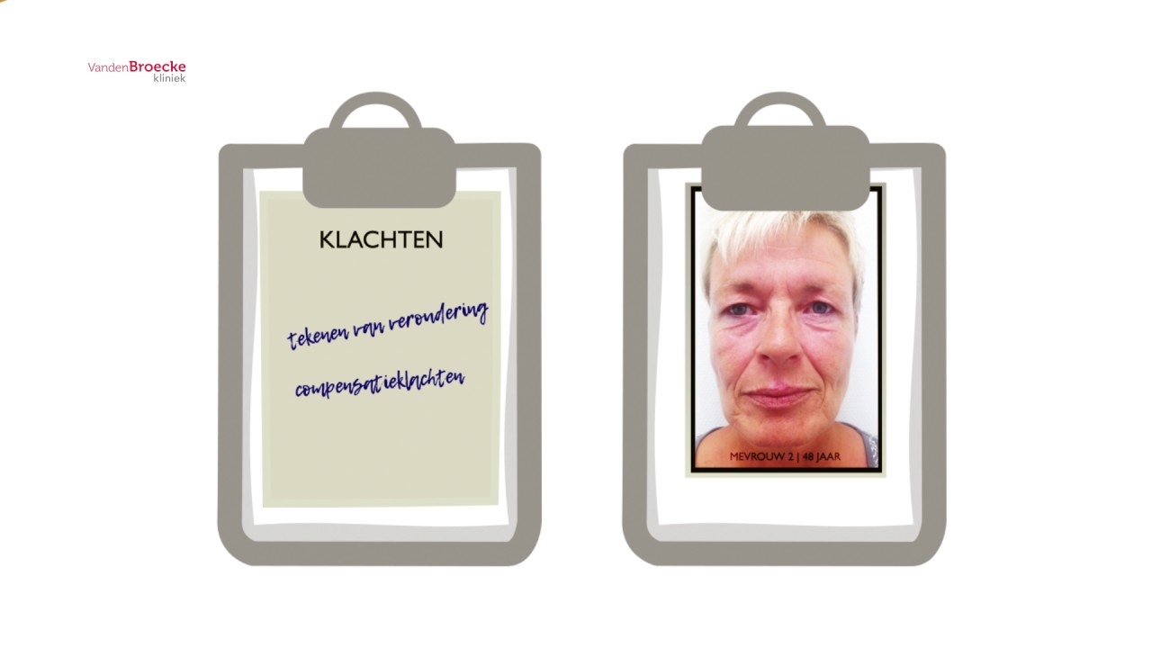Ooglidcorrectie film VandenBroecke Kliniek