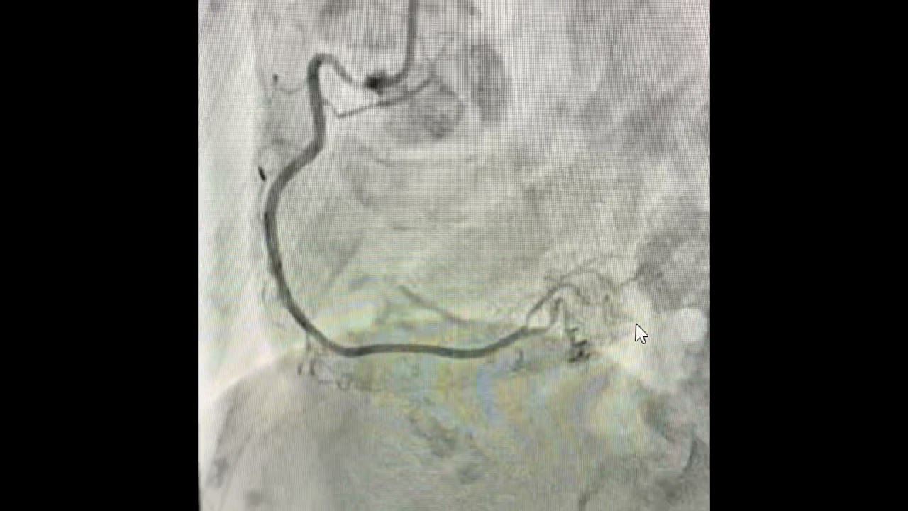 Ostial RCA PCI