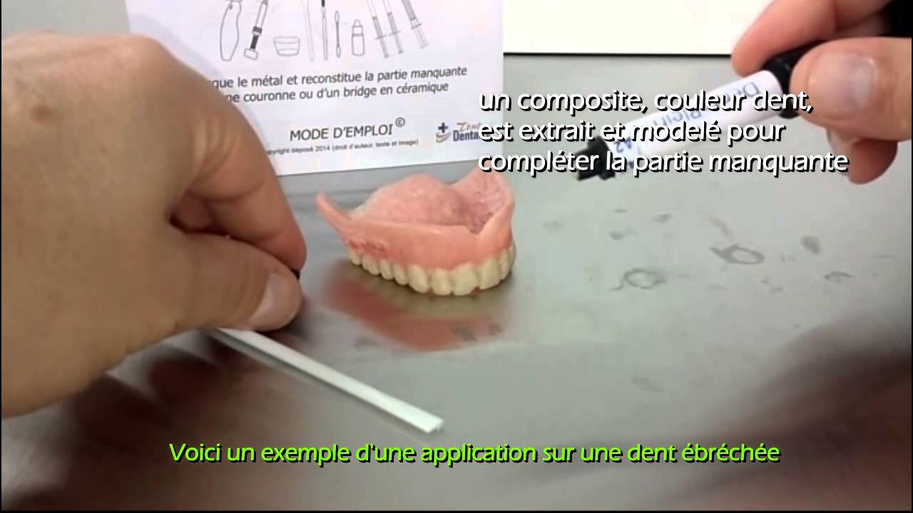 Dentaplein - un kit de réparation pour dent cassée, bridge couronne réparation