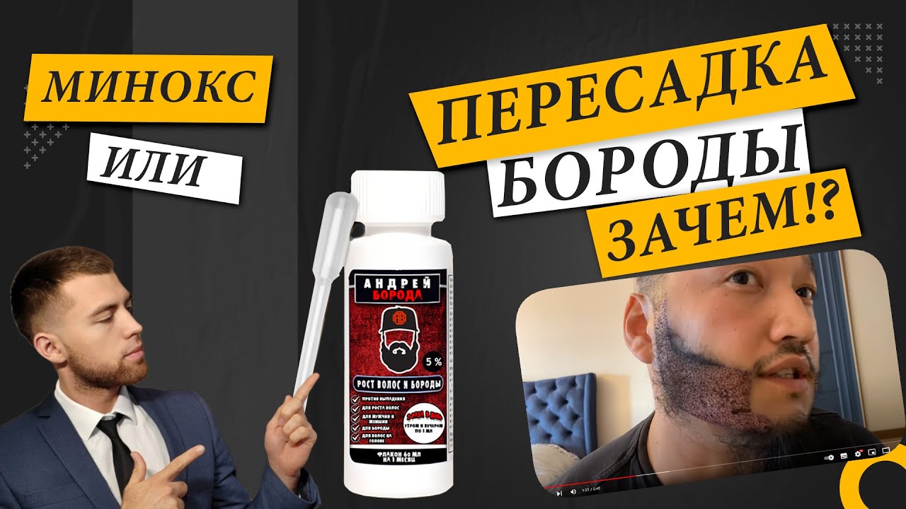 Пересадка бороды, спустя год. Что лучше миноксидил или пересадка бороды? Выпуск 13