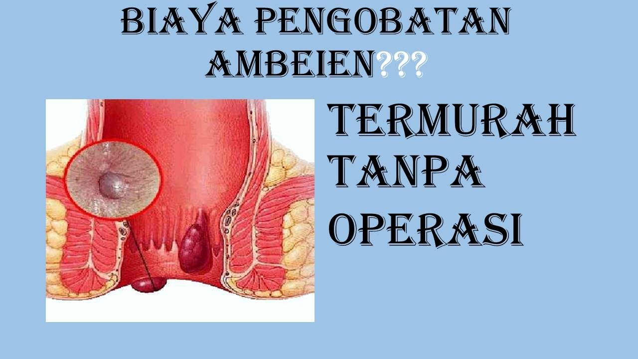 Biaya Operasi Wasir  Hemoroid  Ambeien