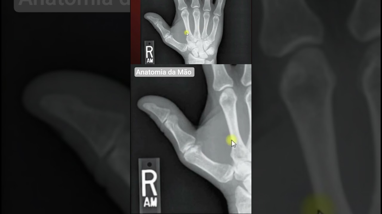 Anatomia da m&atilde;o.                    #anatomia #radiografia #m&atilde;o #metacarpo #radiologia