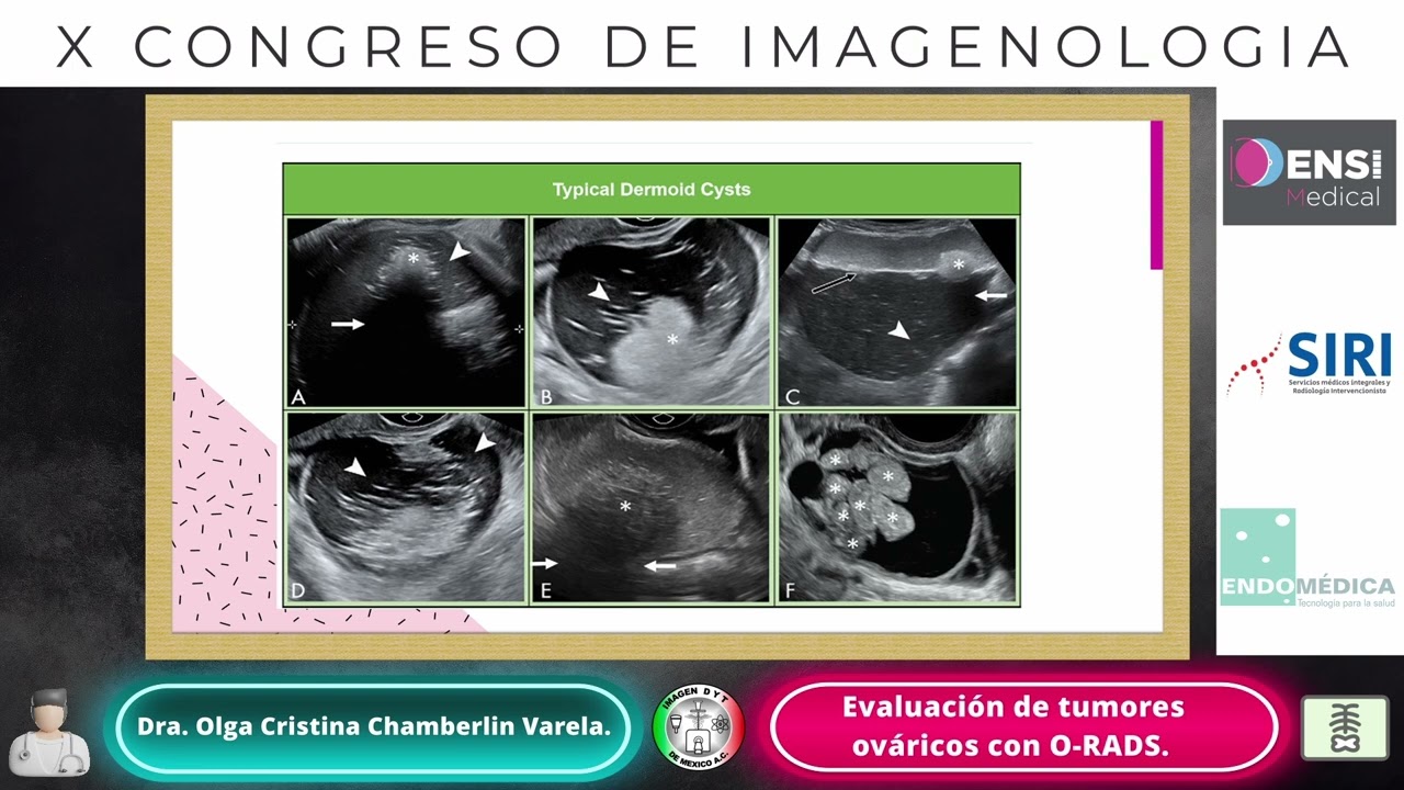 Dra. Olga Cristina Chamberlin Varela - Evaluación de tumores ováricos cpm O-RADS