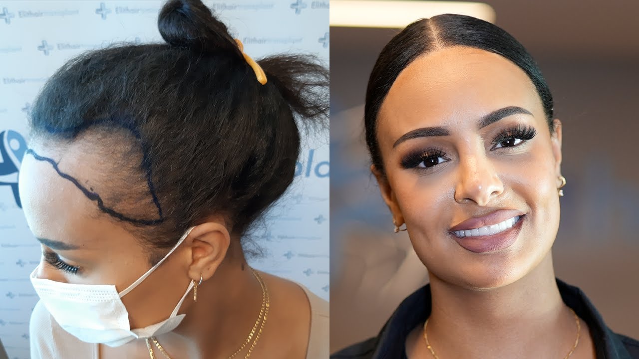 Haartransplantation Frauen | Ergebnis | Zufrieden? I Natürlich? I 12 Monate